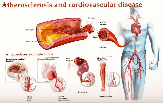 Atherosclerosis-Purify-Your-Clogged-Arteries-2[1].jpg